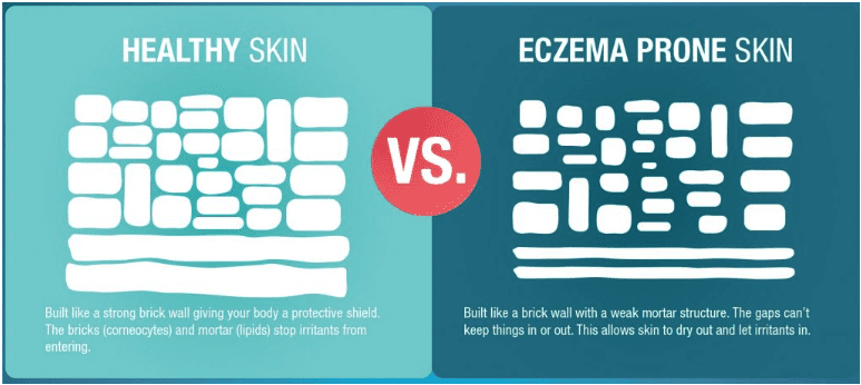 baby eczema itch relief